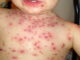 Epidemie de rujeolă în România. Ministerul Sănătății raportează aproape 2.000 de cazuri
